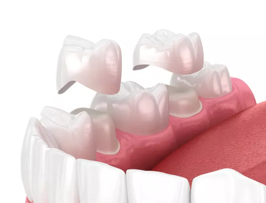 Ceramic Dental Crowns | Benefits, Cost & Procedure