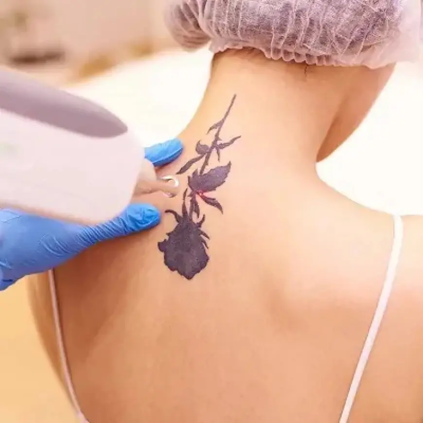 Tattoo Removal in Dubai: Personalized Treatment Plans