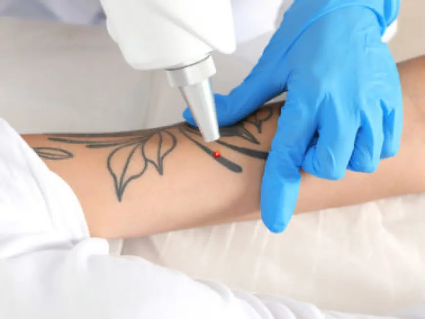 Tattoo Removal in Dubai: How Smoking Affects Healing