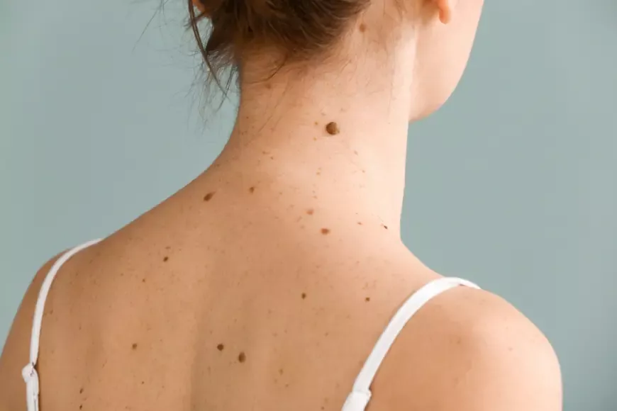 Birthmark Removal in Dubai: Comprehensive Guide