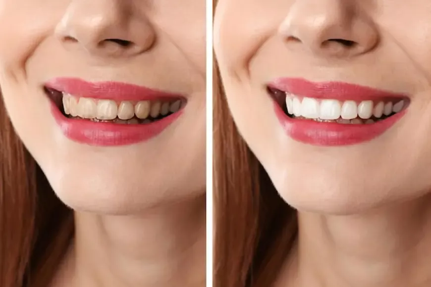 How Does Teeth Whitening Affect Dental Crowns?