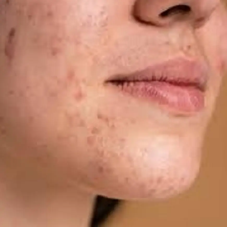 How to Stop Acne Scars Before They Form