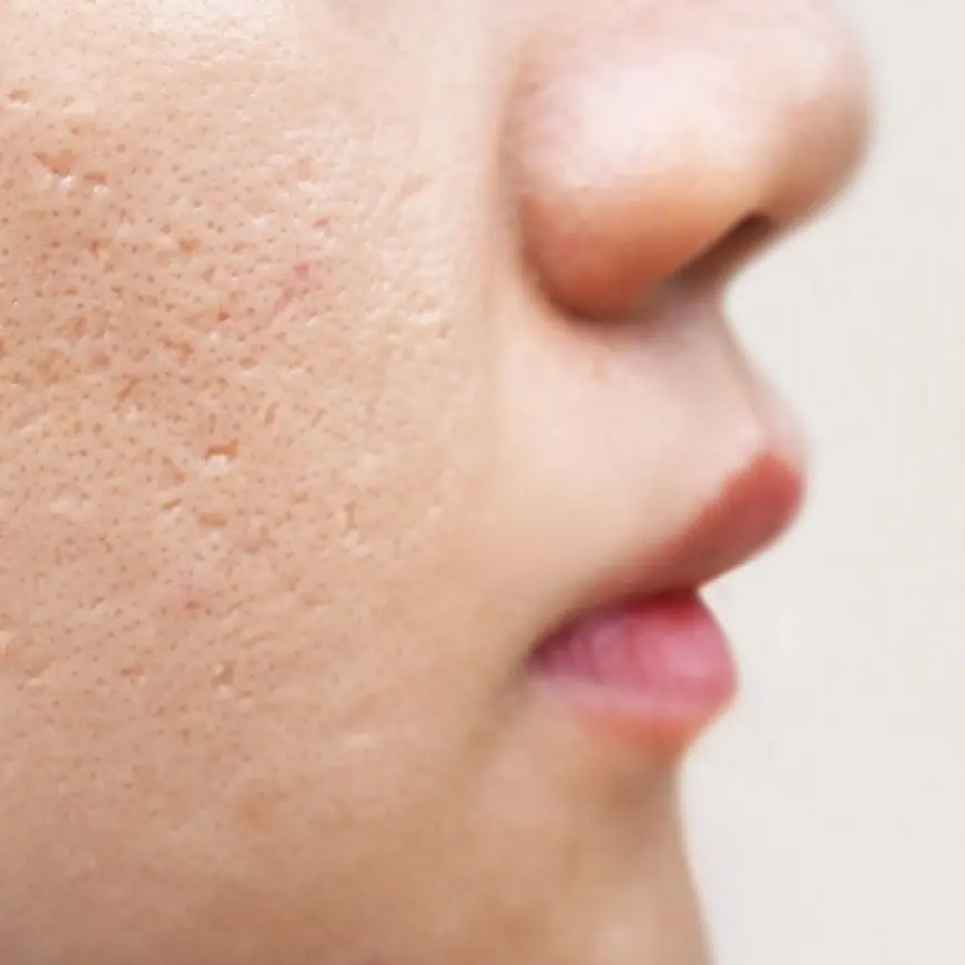 Can Acne Scars Come Back After Treatment?