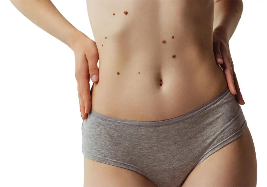 Skin Tag Removal: What You Need to Know