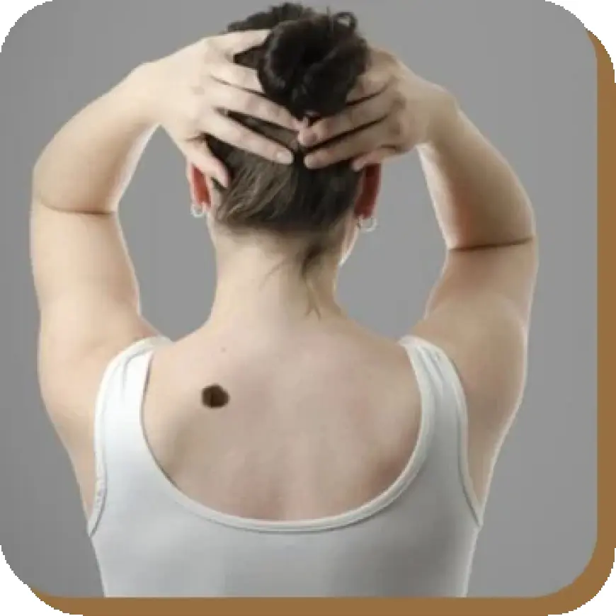 Birthmark Removal in Dubai: Recovery Process