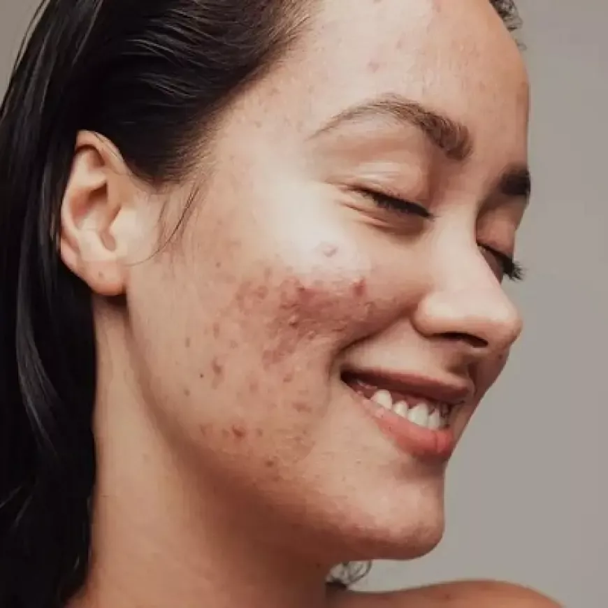 Understanding the Different Types of Acne Scars and Their Treatments