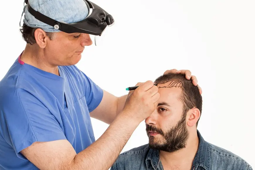 How Long Does a Hair Transplant Surgery Take?