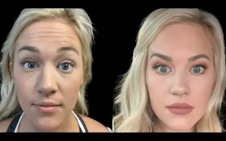 Forehead Botox Done Right: Techniques from the Best Doctors in dubai