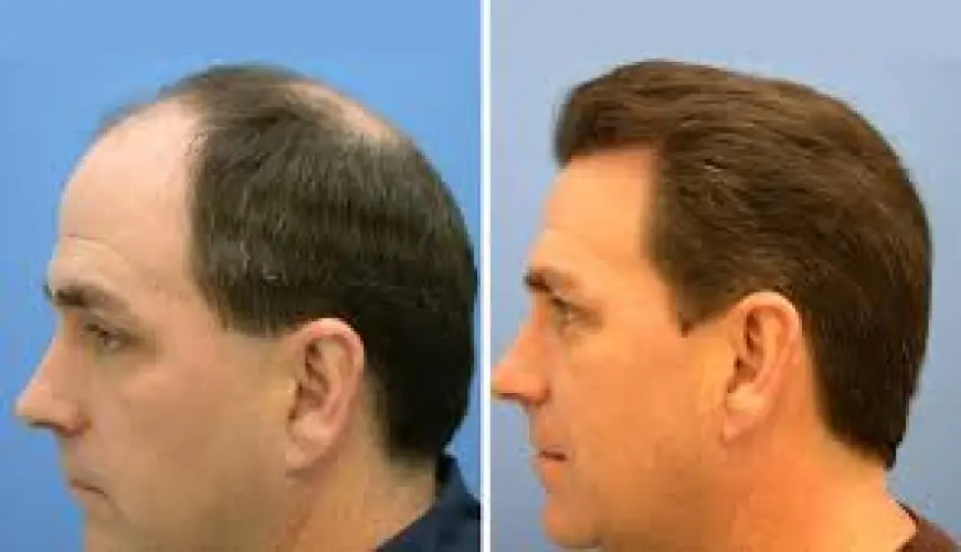 Achieve Natural Hair Regrowth with a Scalp Hair Transplant in Dubai