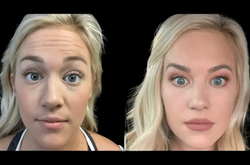 Forehead Botox Done Right: Techniques from the Best Doctors in dubai