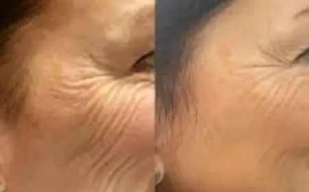 Activate Ageless Charm with Profhilo under Best Plastic Surgeons in dubai