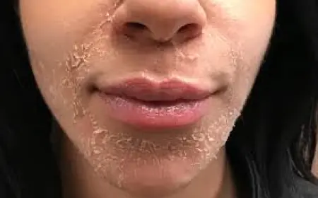 How Do I Know If My Skin Is Ready for a Peel?