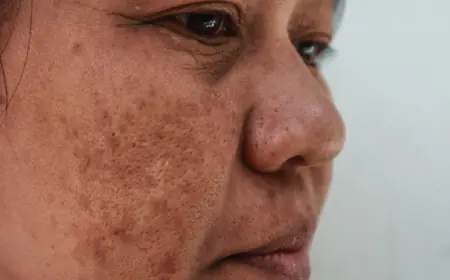 What Is Dermal Pigmentation Treatment Used For?