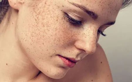 Benefits of Microneedling for Melasma Treatment in Islamabad