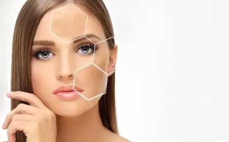 Melasma Treatment: The Truth About Laser Options