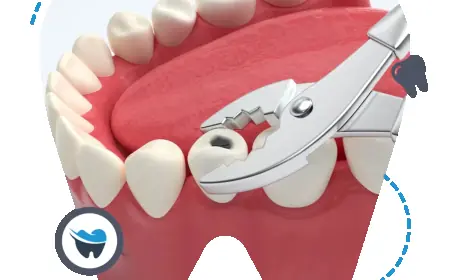 Root Canal vs. Teeth Extraction: A Clinical Comparison