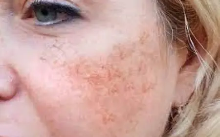 Can Men Get Melasma Too?