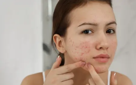 Can Hormonal Acne Be Treated With Standard Acne Treatments?