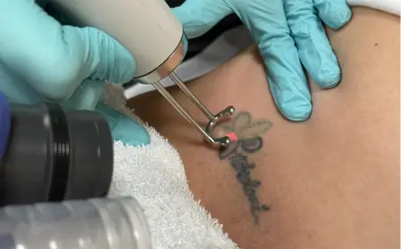 Laser Tattoo Removal: Long-Term Effects Explained