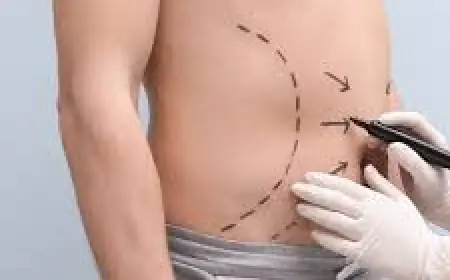Liposuction in Islamabad – A Safe and Effective Body Contouring Option
