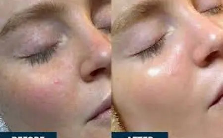 How Does HydraFacial Compare to Chemical Peels?