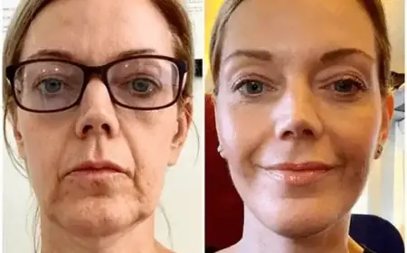 Harness Smoothness through Profhilo in Dubai