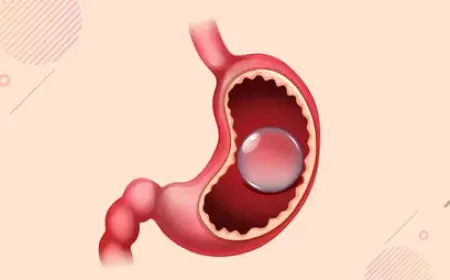 Choosing a Gastric Balloon Type in Riyadh: Your Guide to Weight Loss Options