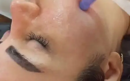 Derma Pen for Melasma – Does It Help?