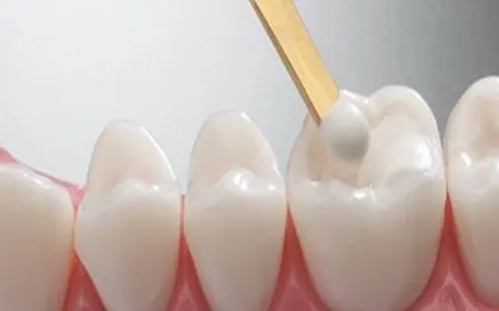The Role of Dental Fillings in Preventing Tooth Decay