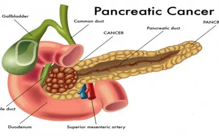 Early Signs of Pancreatic Cancer Singapore Patients Should Watch For