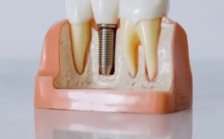 Dental Implants Prevent Bone Loss in Jaw