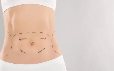 Top-Rated Cosmetic Surgery Centers for Mini Tummy Tuck in Dubai