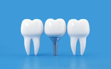How to Care for Your Dental Implants: Daily Tips for Longevity