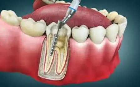 Behind the Smile: Uncovering the Real Cost of Root Canal Treatment