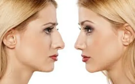 A New Nose, A New You: Understanding the Magic of Rhinoplasty