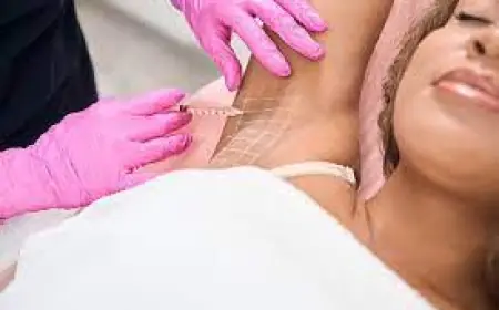 How Many Injections Are Needed for Underarm Botox?