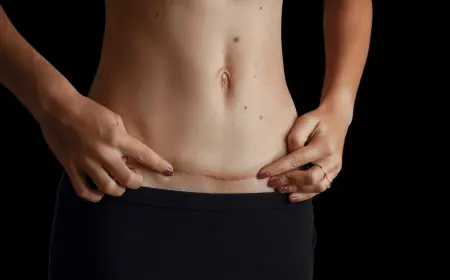 Can You Combine Abdominoplasty with Liposuction in Islamabad?