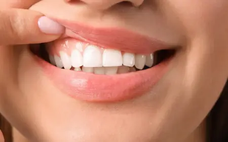 Laser Gingivectomy: Benefits and What to Expect