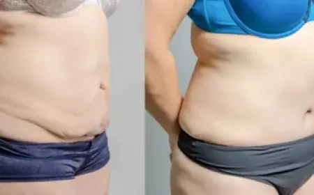 ماذا بعد شفط الدهون؟ خطوات للحفاظ على جسم مثالي