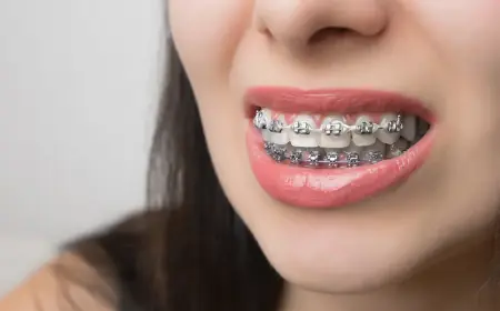 The Role of Orthodontists in Metal Braces Treatment