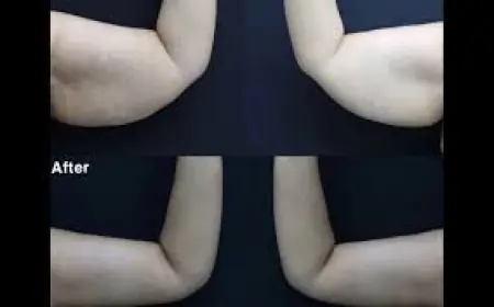 دمج شد الذراعين مع شفط الدهون في الرياض: نتائج مذهلة