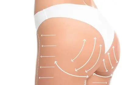 Is Butt Fat Transfer in Dubai the Right Choice for You?
