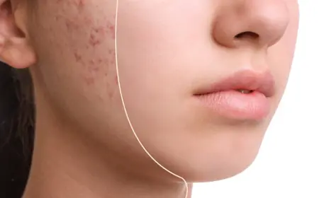 Say Goodbye to Acne Scars: Best Acne Scar Treatment