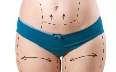 Exploring the Link Between Tummy Tuck in Dubai and Posture Improvement