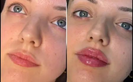 Find Your Perfect Fillers at the Best Aesthetic Clinic in Dubai