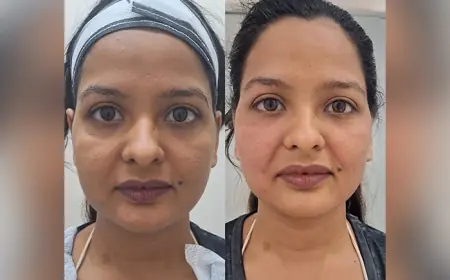 Face Lifting Treatment: Non-Surgical Way to Youthful, Firmer Skin