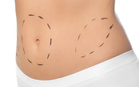 When is the Best Time to Get a Tummy Tuck Surgery?