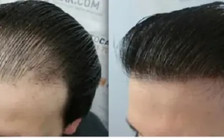 How Many Sessions of Plasma Injection Are Needed for Hair Growth in Dubai?