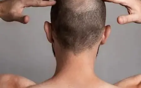 What to Expect One Year After Hair Transplant in Dubai: Realistic Outcomes