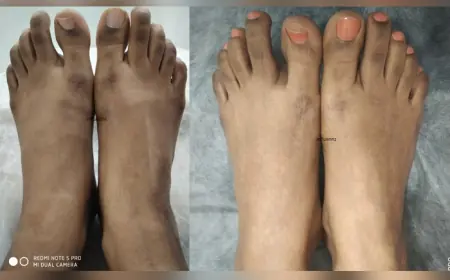 Tanning Removal Treatment: Get Your Natural Skin Tone Back